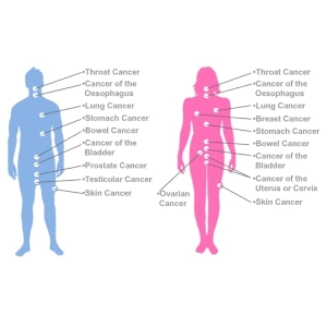 سرطان‌های شایع در انسان