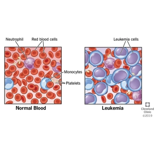 لوسمی و سایر سرطان‌های خونی