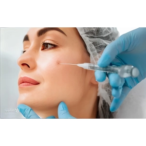 فيلر صورت چيست