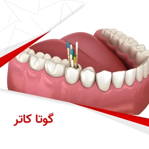 گوتا کاتر در دندانپزشکی