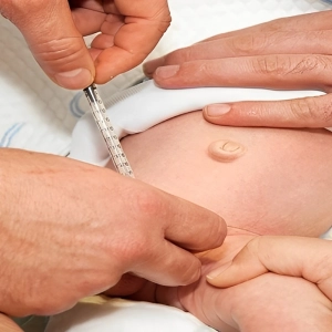 روش کندن پانسمان چسبیده به زخم ختنه