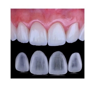 کامپوزیت ips کجایی است؟