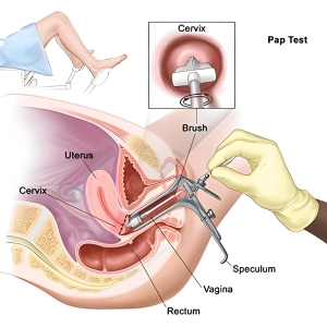 اسپکولوم واژینال چیست