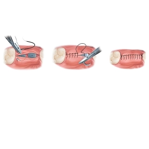مدت زمان جوش خوردن بخیه لثه