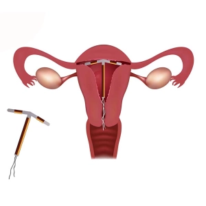 کمر درد بعد از گذاشتن آیودی