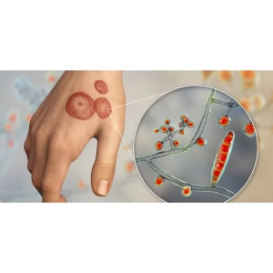 درمان‌های ضدقارچی