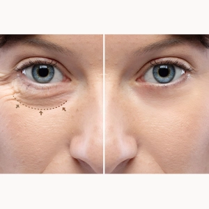 بلفاروپلاستی