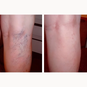 اسکلروتراپی