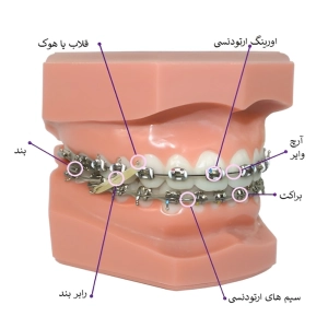 براکت ارتودنسی چیست