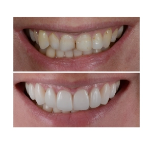 نمونه کار کامپوزیت کاریزما