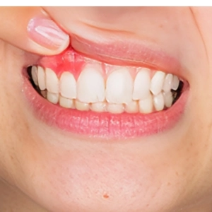 علت سفید شدن لثه بعد از کشیدن دندان