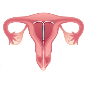 دستگاه جلوگیری از بارداری چیست
