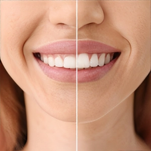 لبخند لثه ای و روش های درمان آن