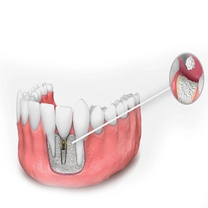 کاربرد پودر استخوان در دندانپزشکی