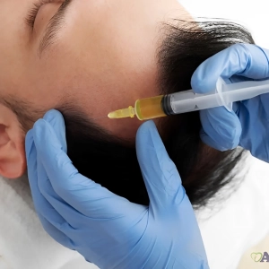 آیا مزوتراپی می‌تواند مانع از ریزش مو شود؟