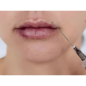 علائم نکروز لب بعد از تزریق ژل