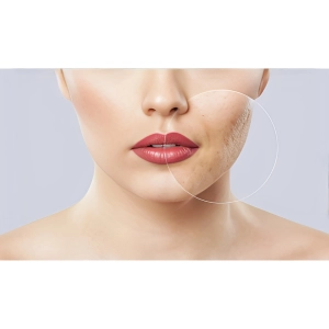 فرق آراف فرکشنال با لیزر فرکشنال