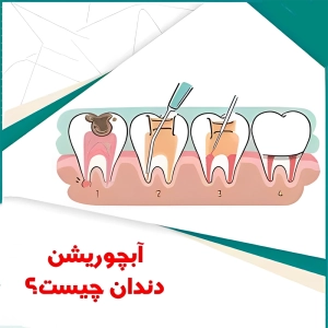 آبچوریشن دندان چیست
