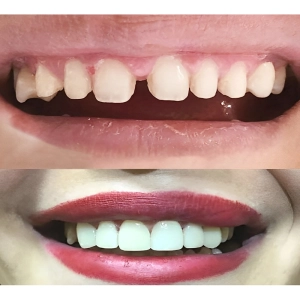 کامپوزیت برای دندان های فاصله دار