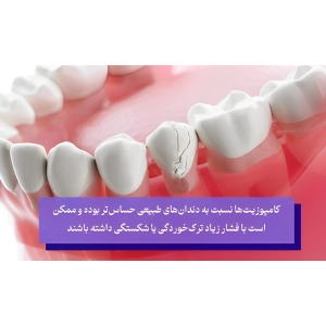 ایا کامپوزیت دندان عوارض دارد