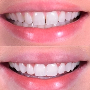 کامپوزیت ای پی اس بهتره یا سارمکو