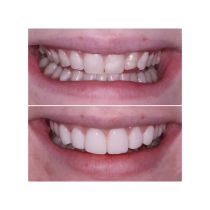 طبیعی ترین رنگ کامپوزیت دندان