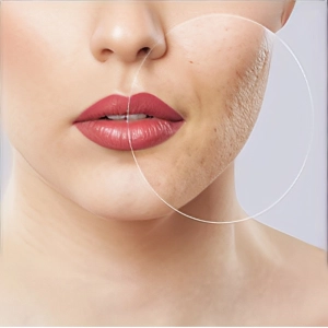 درمان جای جوش