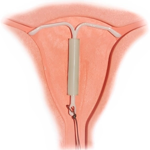 آیودی میرنا برای آندومتریوز