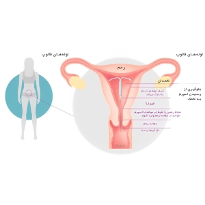 عوارض جانبی آی یو دی میرنا و نحوه مدیریت آن‌