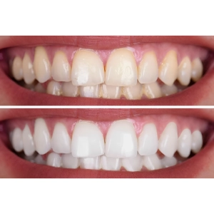 فرق بین بلیچینگ و کامپوزیت