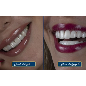 تفاوت کامپوزیت با لمینت دندان