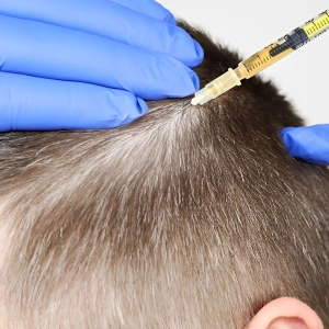 خداحافظی با کچلی: معجزه کوکتل فیوژن مو برای رویش مجدد موهایتان!