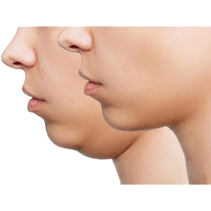 رفع غبغب بدون جراحی : مزوتراپی ارزان ترین روش لیفت غبغب