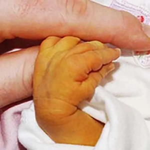 زردی نوزادان و تاثیر دارو های گیاهی و فتوتراپی