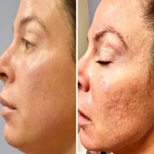 عکس قبل و بعد از پی آر پی صورت