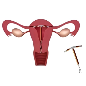 مزایا و معایب آی یو دی میرنا | تجربه 5 سال پیشگیری از بارداری