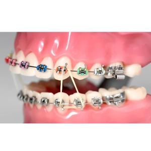 بهترین رنگ براکت ارتودنسی