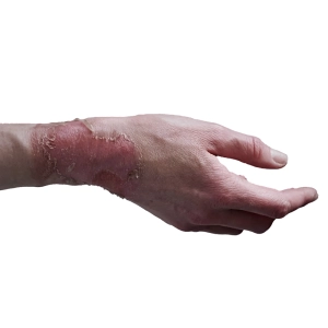 ژل رووفیل: راهکاری موثر برای درمان عوارض سوختگی و آسیب‌های پوستی