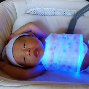 علت زردی در نوزادان چیست ؟