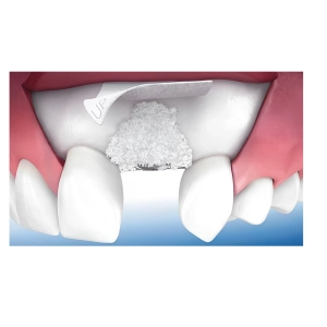 پودر استخوان برای ایمپلنت از چیست