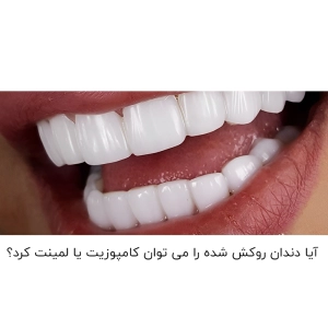 ایا دندان روکش شده را میتوان کامپوزیت کرد