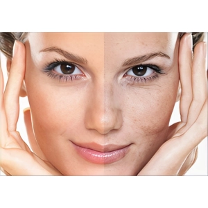 چند جلسه مزوتراپی برای لک صورت لازم است