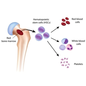 نوآوری‌های درمانی: پیوند مغز استخوان و سلول‌های بنیادی خونی
