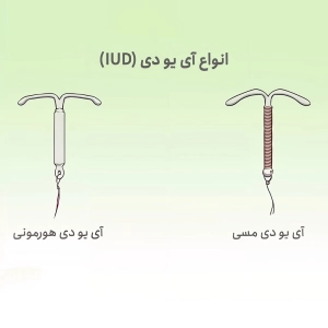 ای یو دی مسی بهتر است یا هورمونی