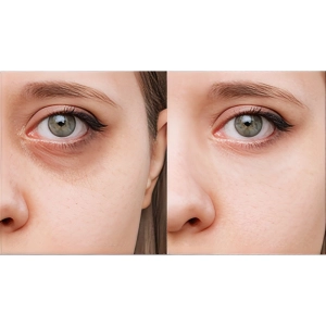 4 فرق مزوژل با فیلر زیر چشم که نمیدانید!