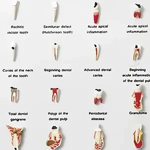 مولاژ بیماری های دندان
