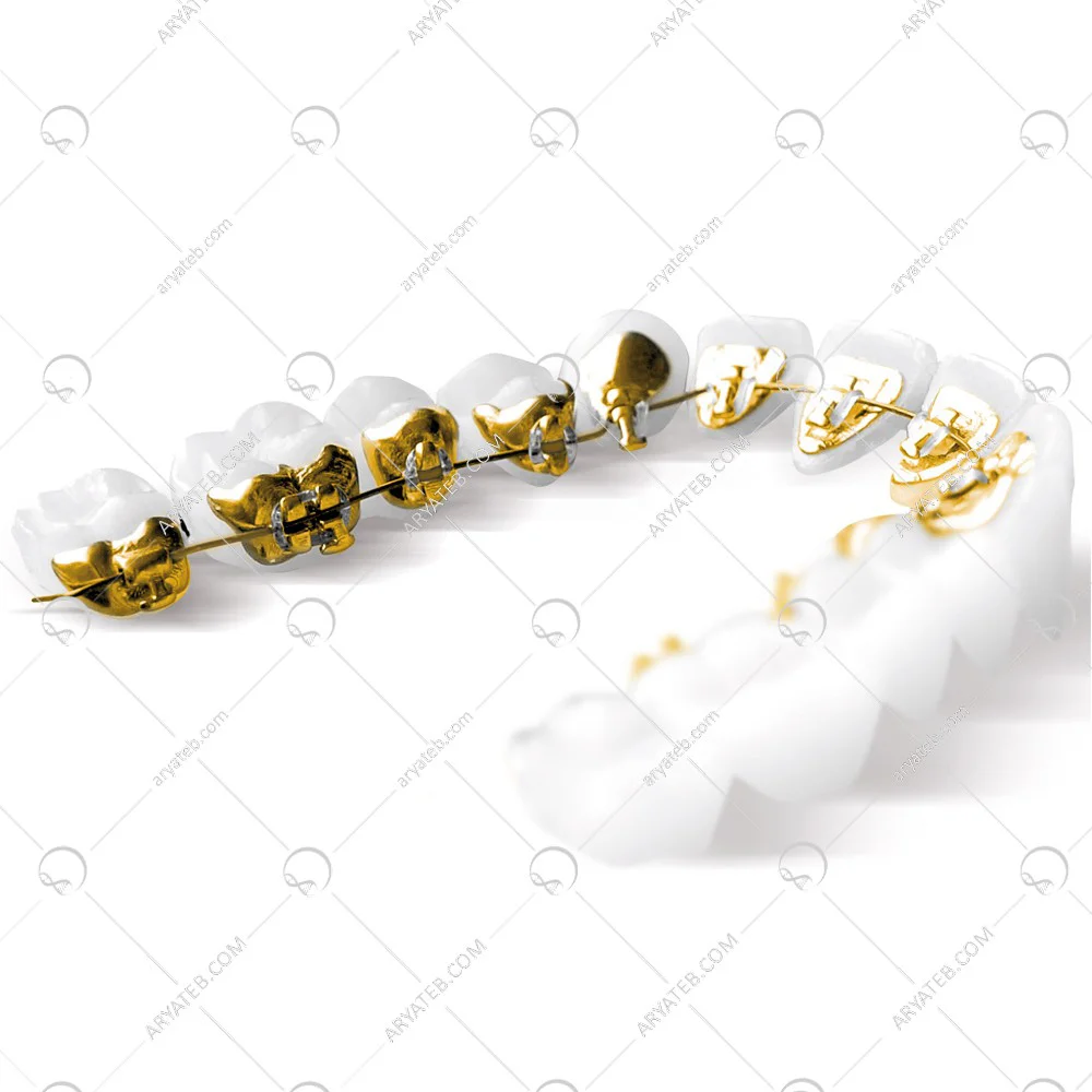 براکت لینگوال