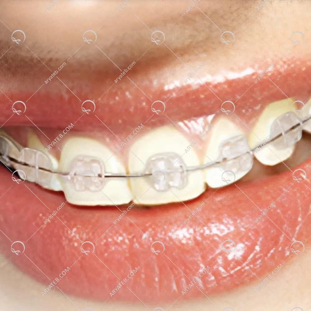 براکت رزینی شفاف