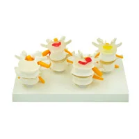 مولاژ مراحل دژنراسیون دیسک