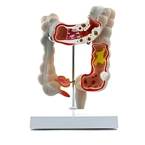 مولاژ روده بزرگ